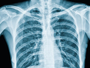 Curso Avanzado de Radiografía Torácica